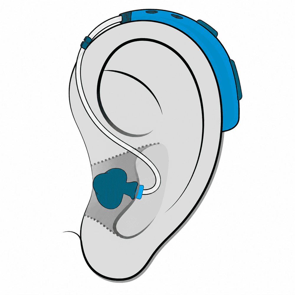Behind-the-Ear (BTE) hearing aid style fitted at Advanced EARGEAR in Ohio