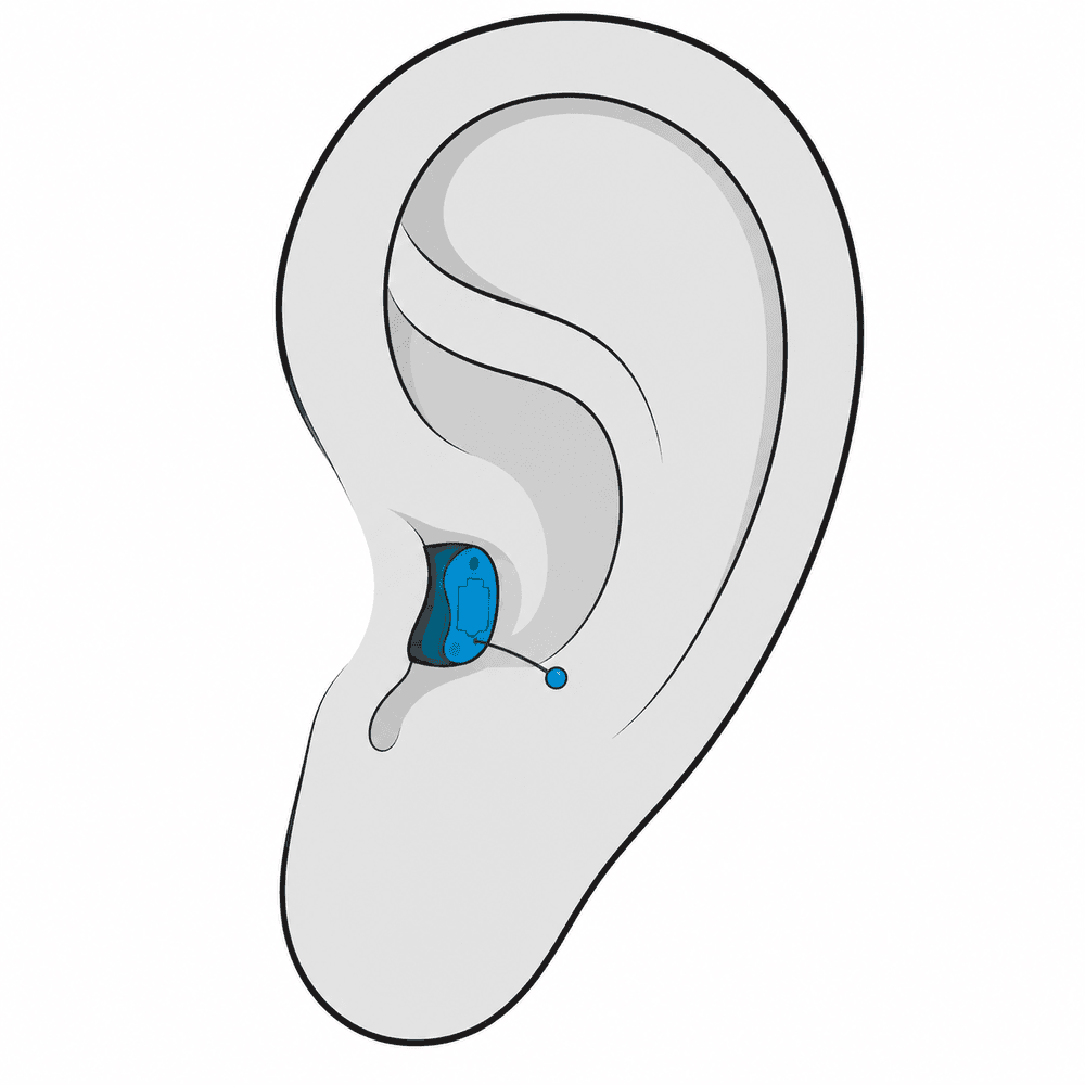 Completely-in-Canal (CIC) hearing aid style fitted at Advanced EARGEAR in Ohio