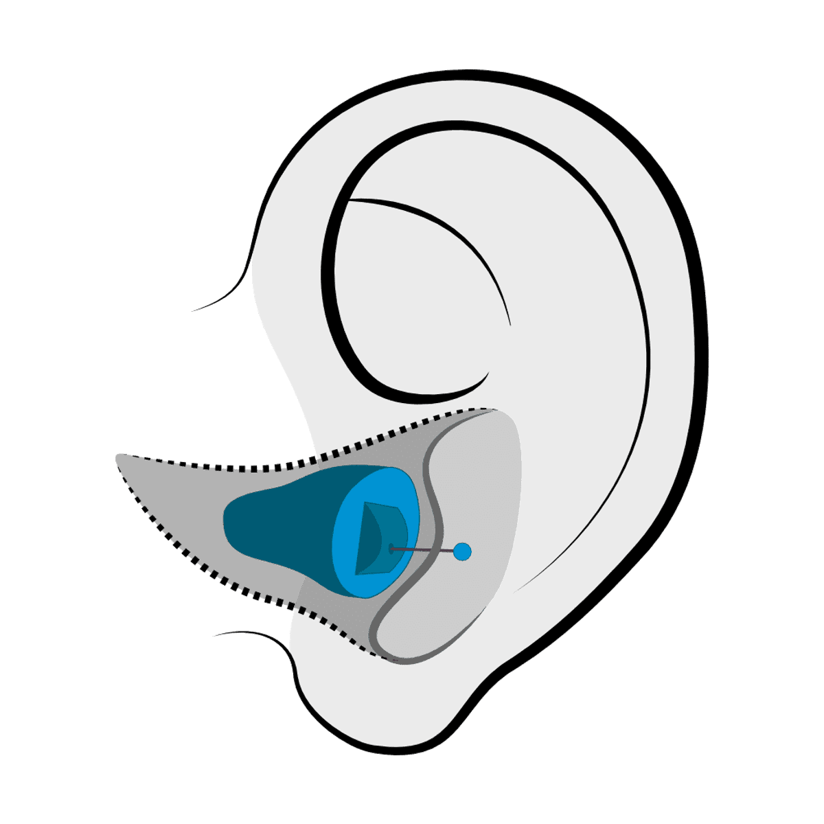 Invisible-in-Canal (IIC) hearing aid style fitted at Advanced EARGEAR in Ohio